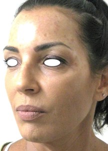 Female patient, cheeks after tretament.